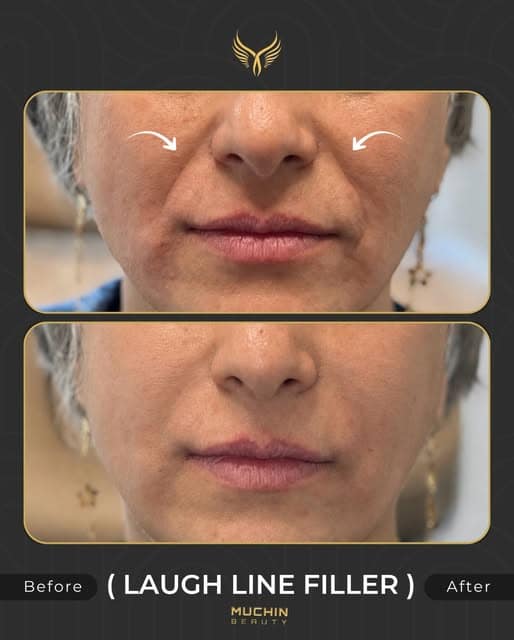 Before and after laugh line filler results at Muchin Beauty Clinic
